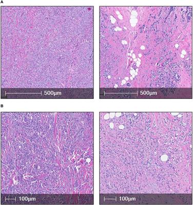 Exploration of cancer associated fibroblasts phenotypes in the tumor microenvironment of classical and pleomorphic Invasive Lobular Carcinoma